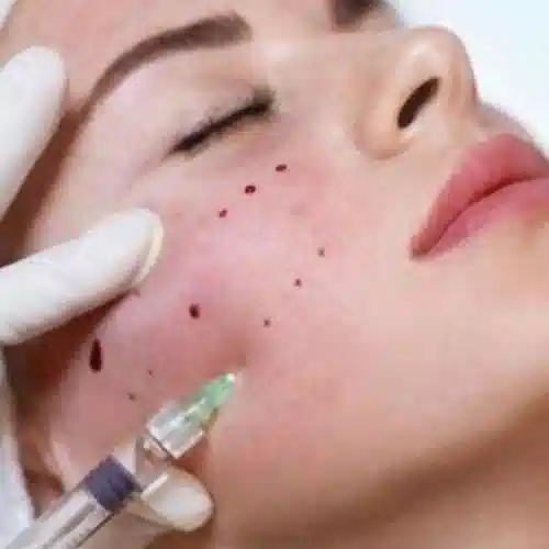 قیمت تزریق فیلر