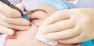 برداشتن خال