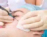 برداشتن خال