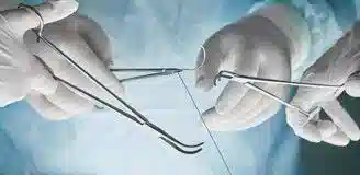 کشیدن بخیه در منزل