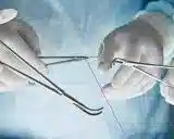 زدن بخیه و کشیدن بخیه